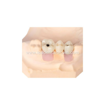 Crown Restoration for Anatomical Implant Placement